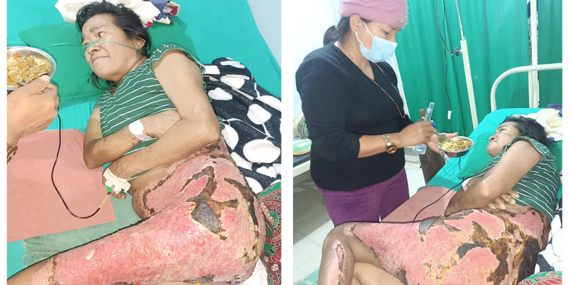 अग्नि पिडित गंङ्गामायाको उपचारमा आर्थिक अभाव