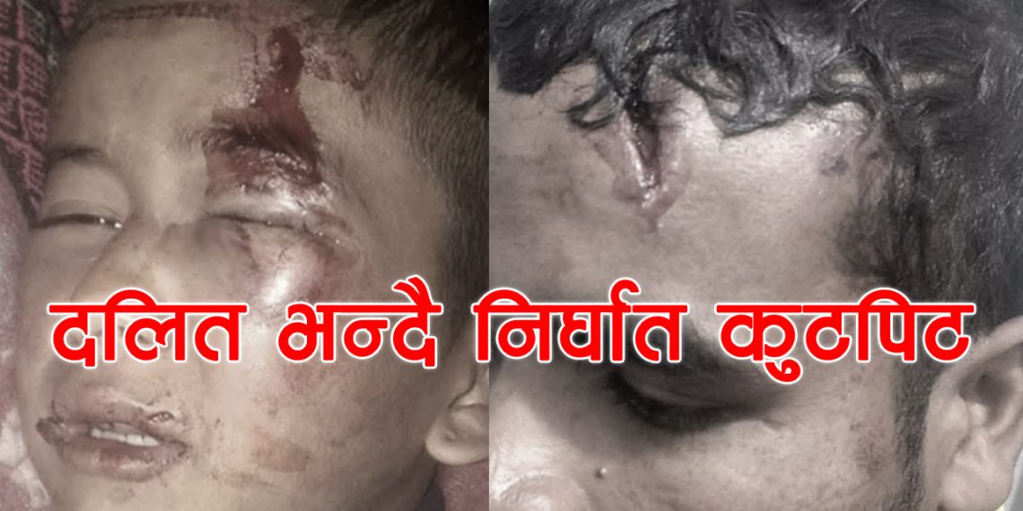 दलित भन्दै नाबालक माथि निर्घात कुटपिट